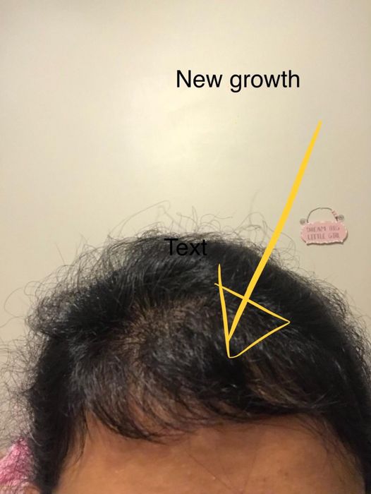 Reviewer showing off new hair growth after regularly using the massaging brush.