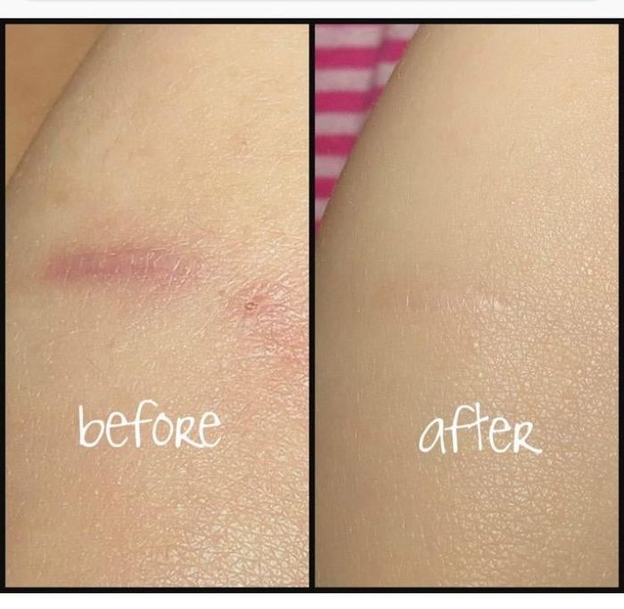 A reviewer’s before-and-after photo, showing the visible reduction of a scar after using the product.
