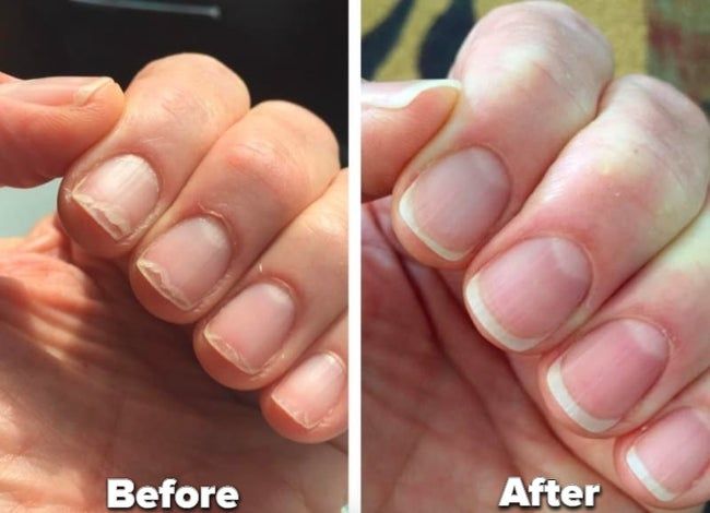 A reviewer’s before-and-after photo showing their nails brittle and breaking before using the oil, and strong after treatment with the oil