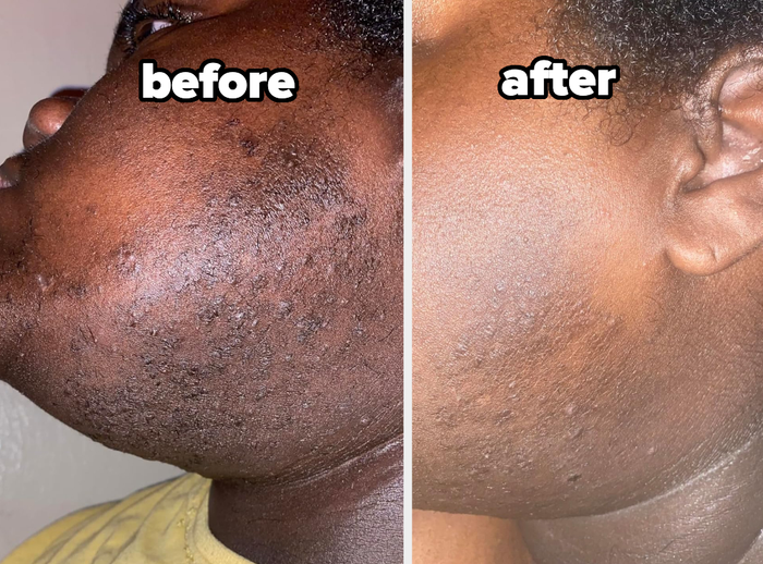 The transformation of a reviewer’s skin after using the toner pads to clear up ingrown hair bumps.