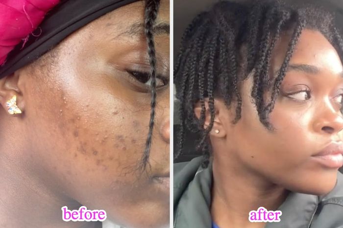 Before and after photos of a reviewer, showing impressive improvement in skin clarity and texture