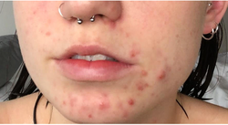 Person before applying the exfoliant toner