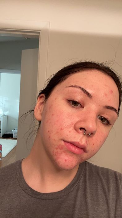 A reviewer’s skin before using the Axis-Y serum.