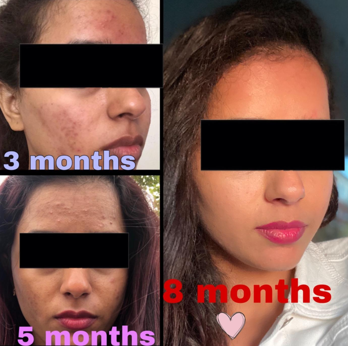 A series of four images showcasing a reviewer’s skincare journey, documenting their progress at 3, 5, and 8 months.