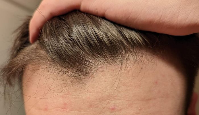 A close-up shot of the same reviewer's hair, now visibly free of dandruff flakes