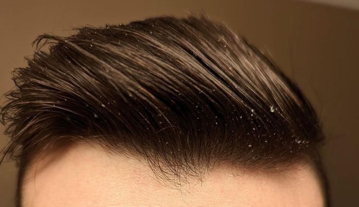 A close-up shot of a reviewer's hair, clearly showing visible dandruff flakes