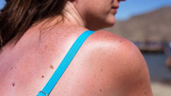 A young woman with a very sunburned back and shoulders