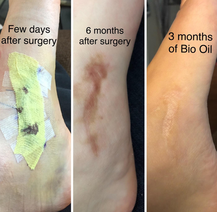 A reviewer’s scar progression photos after surgery, demonstrating how the oil gradually faded their scars
