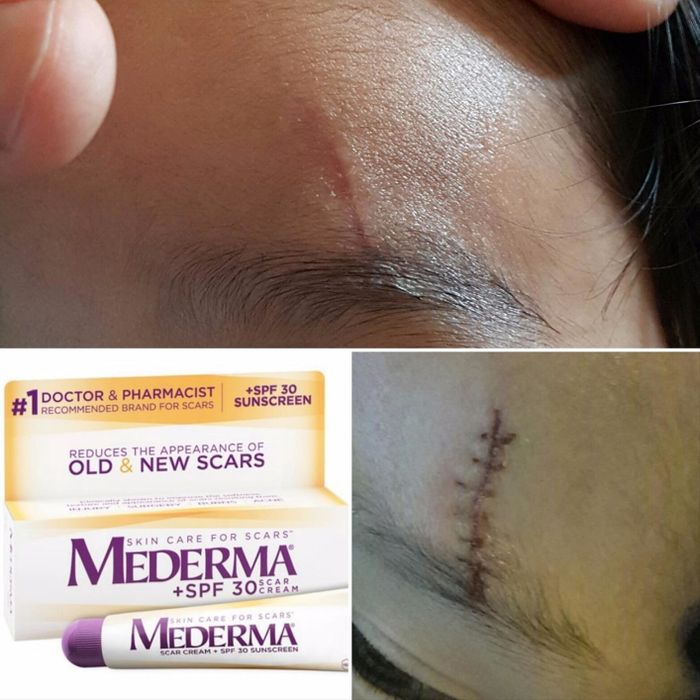 A reviewer’s scar before and after using Mederma cream, showing noticeable improvement