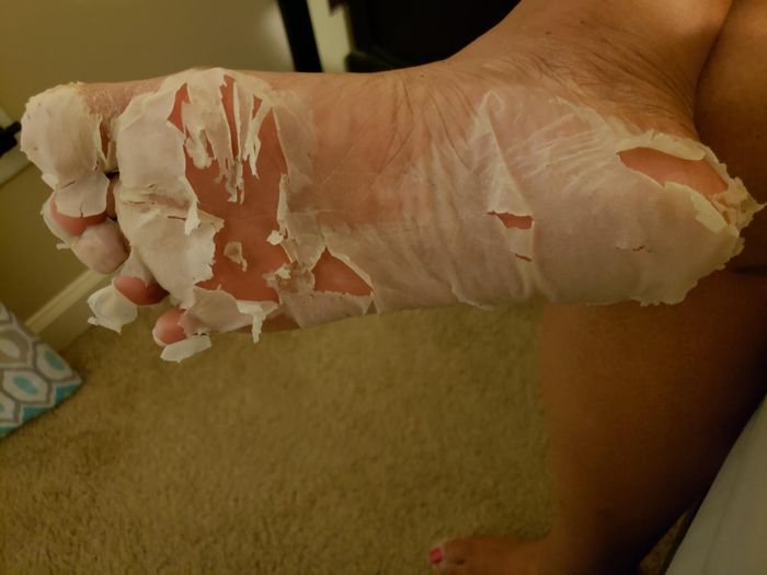 A reviewer’s foot peeling process, revealing fresh, smooth skin underneath