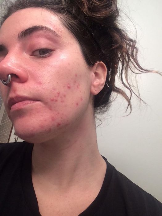 A reviewer displaying acne on their cheek before starting the treatment