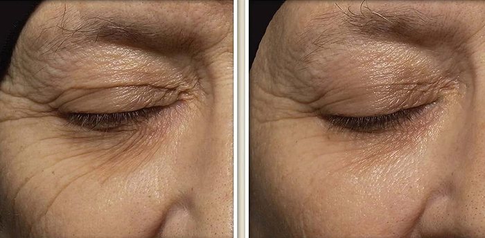 Side-by-side images of a model’s wrinkles before and after using the retinol cream, showing visibly firmer and smoother skin