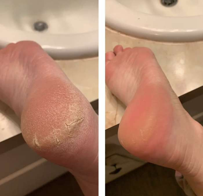 A reviewer’s before-and-after photos demonstrating the results of using O'Keeffe's Healthy Feet foot cream