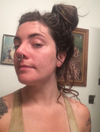 The same reviewer’s skin after using the treatment, showing reduced redness and smoother texture