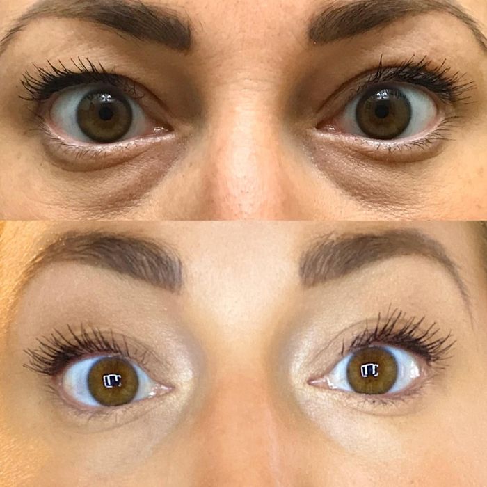 A reviewer's before-and-after photos showing reduced dark circles after applying the concealer