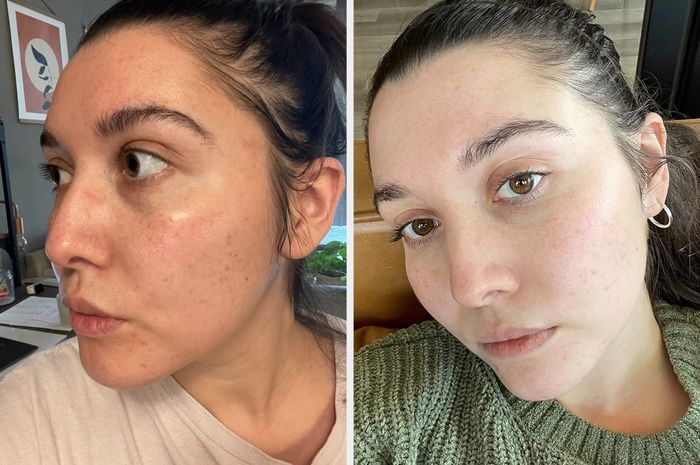 A reviewer's before-and-after photos showing significantly brighter and clearer skin after using the facial device twice daily for two months