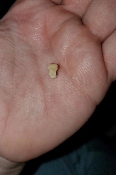A reviewer holding a tonsil stone they successfully removed using the kit