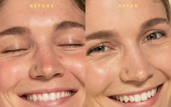 Before-and-after images of a model showing redness reduction and a clearer complexion