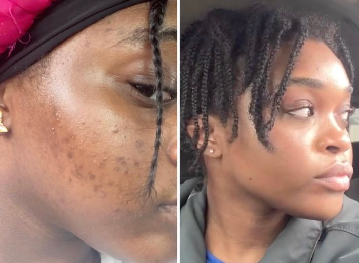 A before-and-after comparison showcasing a reviewer's skin transformation after treatment