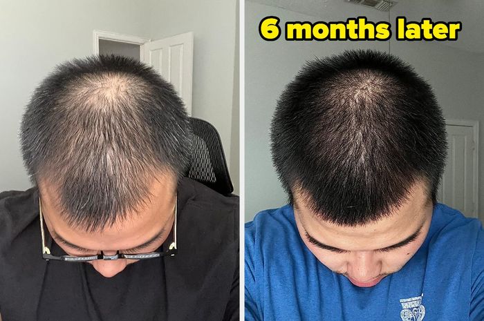 A reviewer's transformation showing visibly fuller and thicker hair after six months of using the biotin shampoo