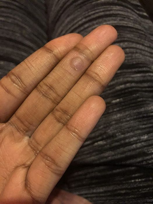 An after photo of the same reviewer's finger, now wart-free