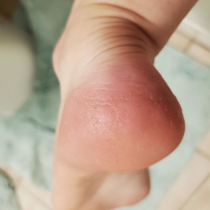 The same reviewer's heel after using the file, now smooth and free of calluses