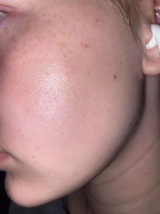 A close-up of a reviewer's cheek showcasing visible pores and blemishes, emphasizing common skincare issues