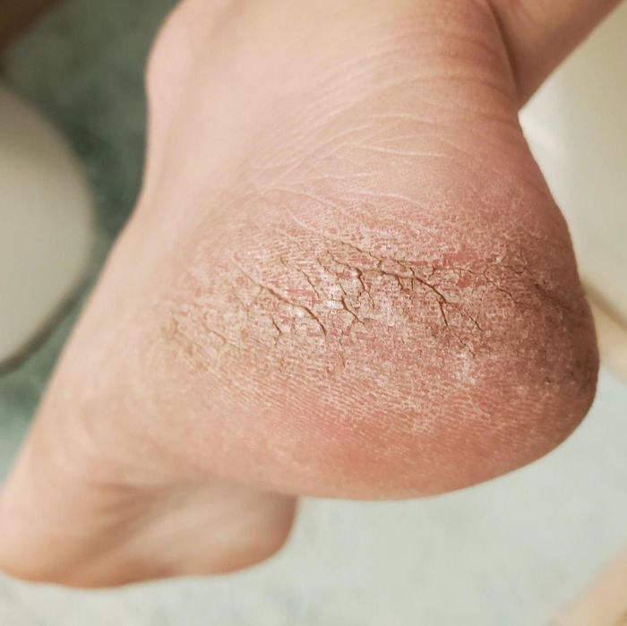 A reviewer's dry, calloused heel before treatment