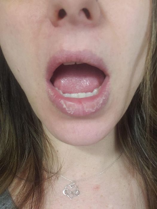 Before image of a reviewer with visibly cracked and dry lips