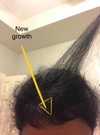 A different reviewer showcasing new hair growth at the front of their scalp