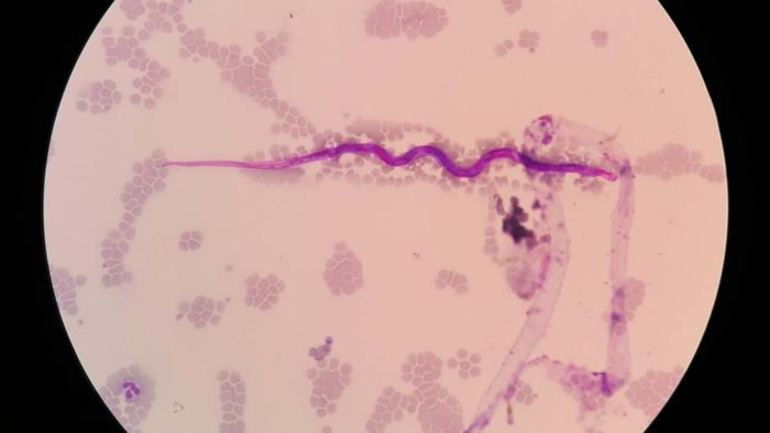 Filarial worms infection