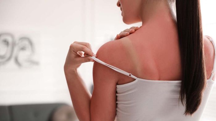 How to Determine If Your Sunburn Needs Medical Care