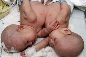 Conjoined twins born in China