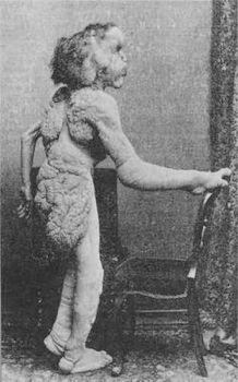Normal Elephant Man