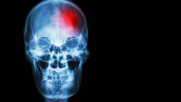 Cerebral Stroke