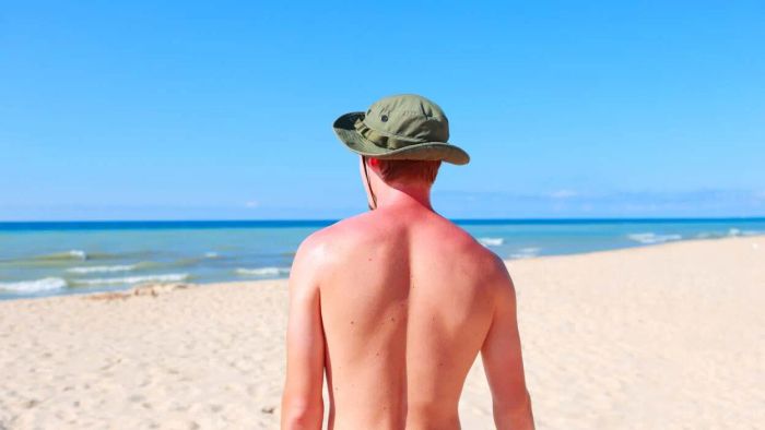 Steps to Alleviate Painful Sunburn