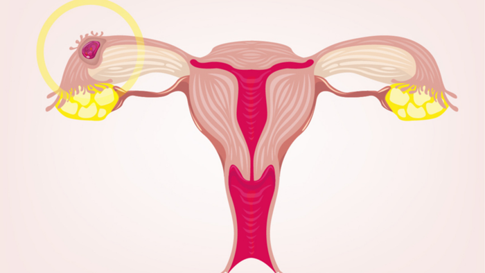 Exploring why an ectopic pregnancy cannot be 'reimplanted'.