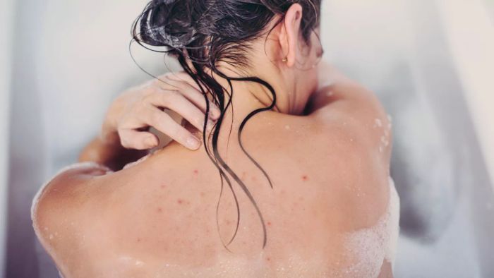 A woman in the shower with visible fungal acne on her back