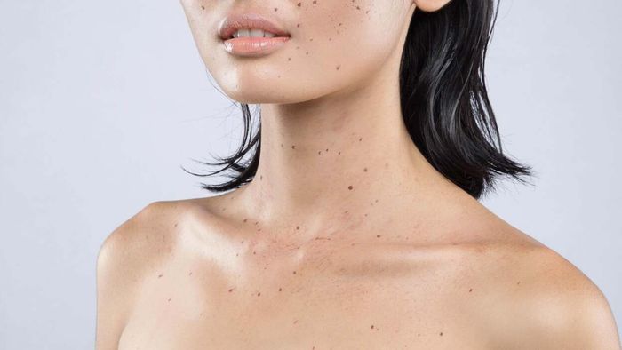 Is a Mole-Checking App Right for You?