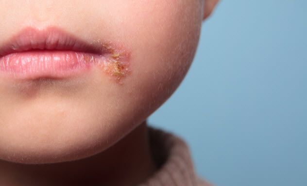 6d-herpes_23755697_SMALL
