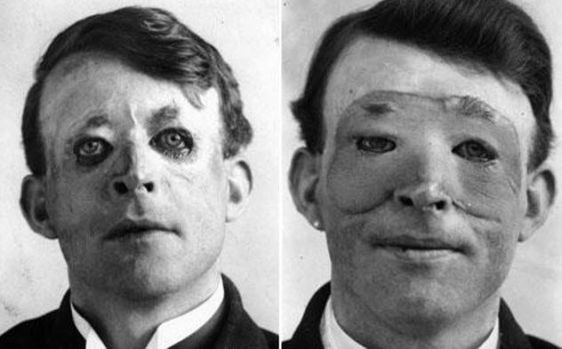8-gillies-skin-flap-surgery