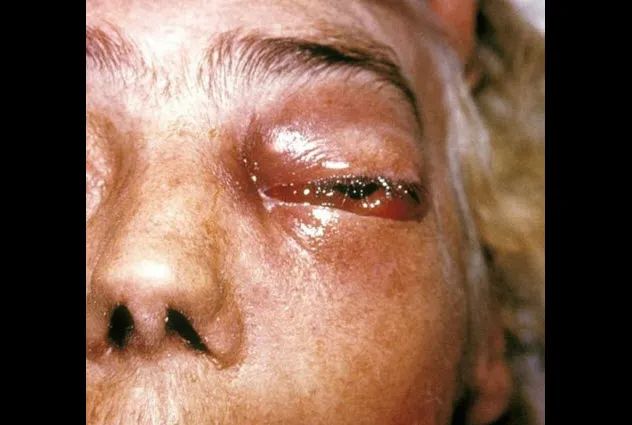 9-mucormycosis