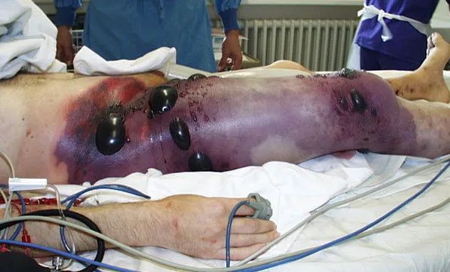 5-gas-gangrene