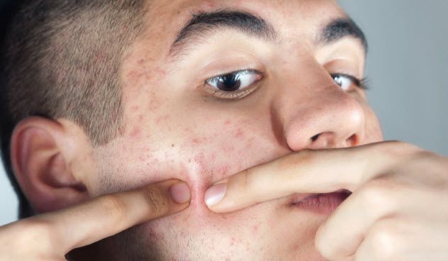 10-acne_000016977363_Small