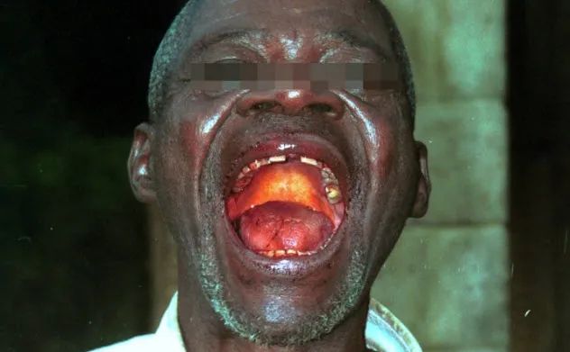 8-ebola-patient