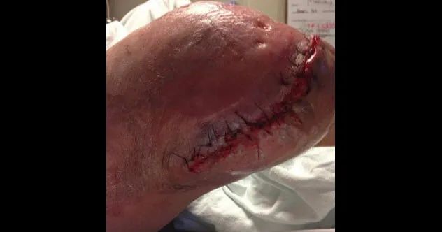 10a-feature-Necrotizing-Fasciitis