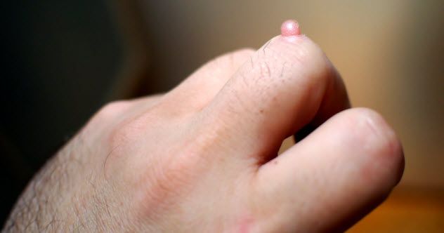 9-wart_000082299563_Small