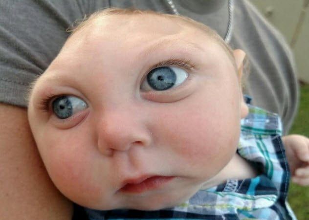 5-zika-virus-baby
