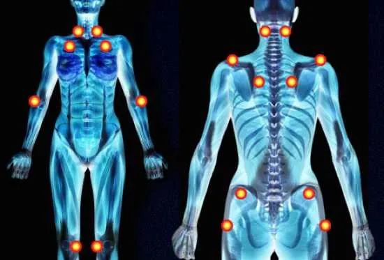 Fibromyalgia
