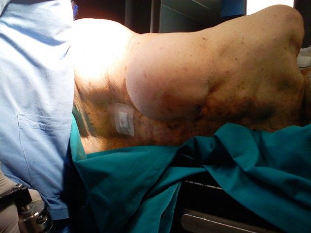 800px-Lipoma
